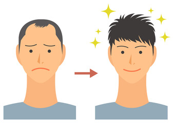 AGA治療をした男性のイラスト　ハゲ頭　ベクター素材