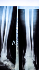 X-ray of a patient with a fracture of the fibula of the middle tibia close-up in the hospital on a reflective board to view X-rays of patients.