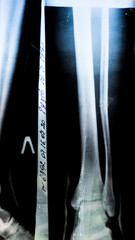 X-ray of a patient with a fracture of the fibula of the middle tibia close-up in the hospital on a...