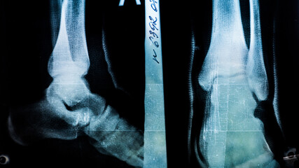 X-ray of a patient with a fracture of the fibula of the middle tibia close-up in the hospital on a...