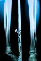 X-ray of a patient with a fracture of the fibula of the middle tibia close-up in the hospital on a...