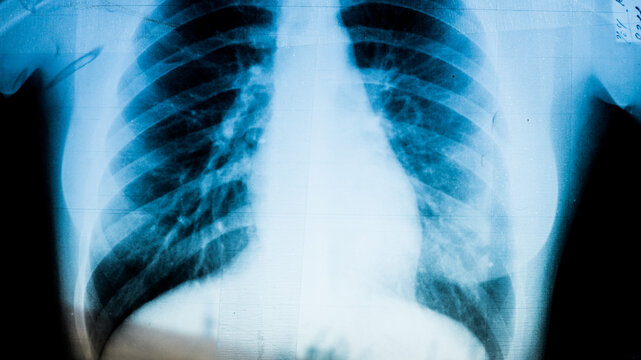X-ray of pneumonia disease patient close up on reflective x-ray board in hospital.