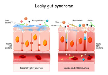 Leaky gut Syndrome - obrazy, fototapety, plakaty