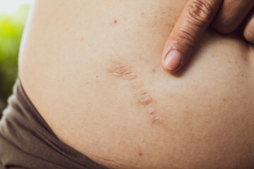 A scar on a woman's stomach caused by surgery,woman belly with a scar ,Postoperative abdominal scars,	
