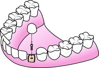 Endosteal or Endosseous implant: the implant is placed into the jaw bone with an abutment to which the prosthesis is attached.