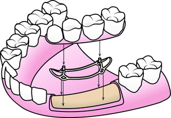 Subperiosteal implant: a saddle-shaped frame is placed on top of the jaw bone. The prosthesis is attached to the posts that protrude above the gum.