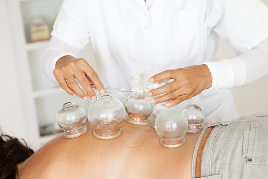 Alternative Medicine: Female Doctor Applying Suction Cups (Cupping)
