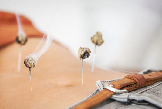 Alternative Medicine: Acupuncture on Belly