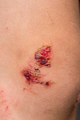 Fototapeta premium Deep scratches on the skin with bruises on the child?s knee. Wounds, scratches, abrasions on the child?s leg, knee close up