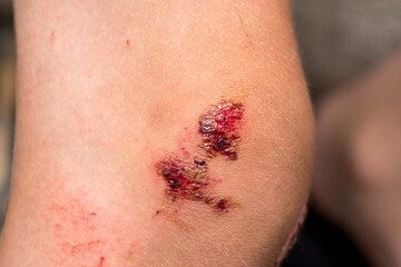 Deep scratches on the skin with bruises on the child?s knee. Wounds, scratches, abrasions on the child?s leg, knee close up