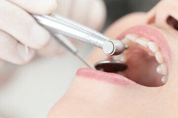 Obraz na płótnie Canvas 歯の治療