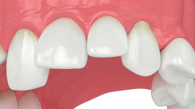 Closeup of upper jaw with abnormal teeth position. Orthodontic treatment concept. 

