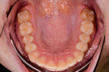 upper jaw after orthodontic treatment © Dirk