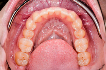 Obraz premium lower jaw after orthodontic treatment