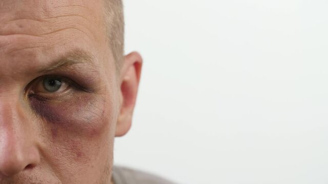Man with black eye looks at the camera