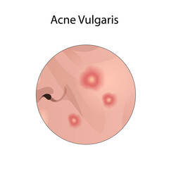 Fototapeta premium Acne vulgaris. Young woman face with skin inflammation. Close-up view.