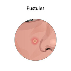 Acne. Pustules. Young woman face with skin inflammation. Close-up view.