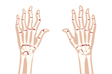 Arthrits x ray