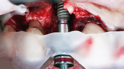 installed dental implant and lack of bone in the upper jaw of the central tooth © Dental Pro Content
