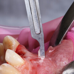 dental scalpel cuts the patient's gums for plastic surgery and volume augmentation