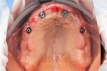 reconstructed gingiva after implantation on multi-unit for upper jaw prosthetics