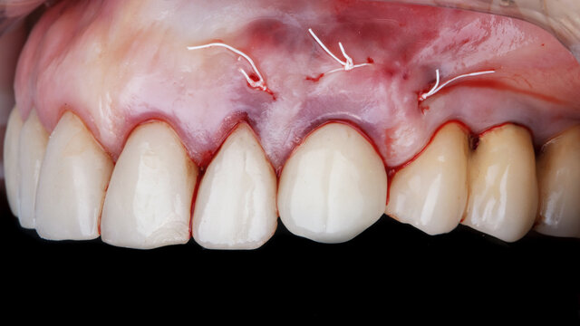 Installed Canine Crown With Immediate Loading After Implantation