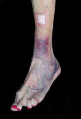 Blood clot on old woman with osteoarthritis. The woman is in the age 85.