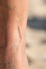 Fototapeta premium varicose veins on the male foot