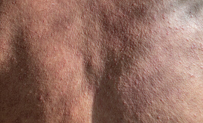 Fototapeta premium Rough skin of the back of elderly men