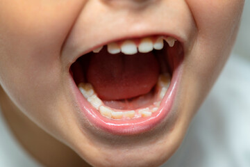 A little boy with an open mouth showing milk teeth and constantly growing teeth.