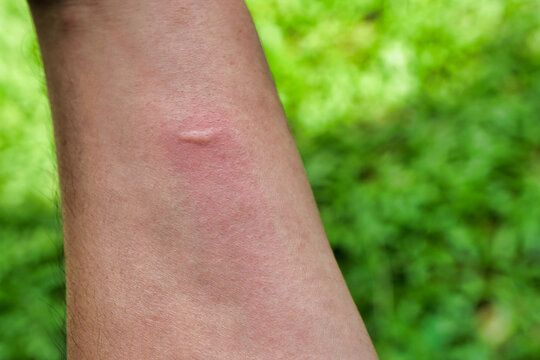 Symptoms of insect sting allergy. Rash on skin caused by insect bites.