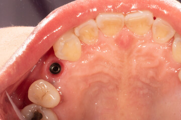 Gingival cuff after remove healing abutment from dental implant © bubykung