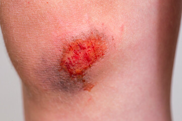 Fototapeta premium Children injury. Deep scratches on the skin with bruises on the child knee. Wounds, scratches, abrasions on the child leg
