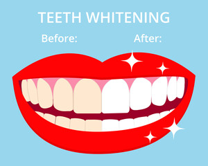 Teeth Whitening concept woth laughed mouse and teeth before and after bleaching. Vector isolated elements on blue background. EPS10