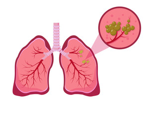 Lung cancer concept on white background.
