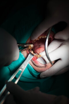 Teeth operation