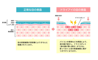 ドライアイの目・目の渇き 目の表面断面図イラスト
