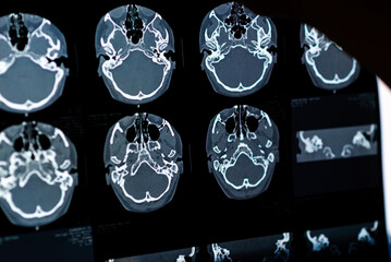Brain CT scan x-ray film image Brain