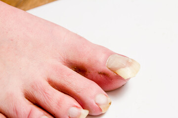 Men's unkempt feet with long uncut nails. The concept does not follow itself.