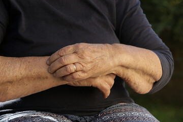 Elderly caucasian woman scratching dry skin on her arm. Senior dry skin problem.
