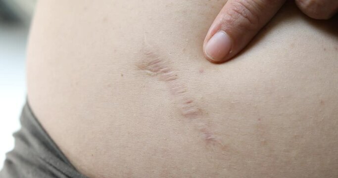 A scar on a woman's stomach caused by surgery,woman belly with a scar ,Postoperative abdominal scars,	
