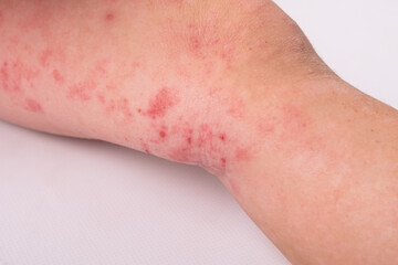 rash on a child leg isolated on white background, redness, allergic reaction, dermatitis symptom