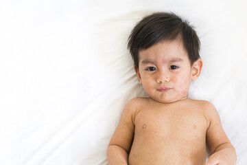 A cute asian little baby boy is laying on the bed while he has skin problem from viral infection, concept of healthcare, illness and skin problem in pediatric. - obrazy, fototapety, plakaty