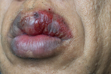 Obraz premium Herpes on the lips in men causes pain, burning, swelling, inflammation.