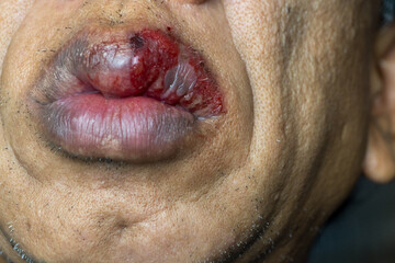 Obraz premium Herpes on the lips in men causes pain, burning, swelling, inflammation.