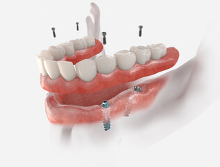 Mandibular fixed restoration with 4 implants, posterior are tilted.  3d illustration of implant on white background. Dental prosthetic innovation.
