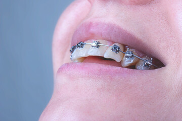 Beautiful of teeth with braces. Dental care photo. Young woman smile with orthodontic accessories. Orthodontics treatment.