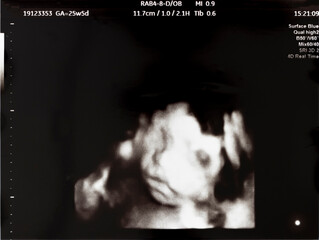妊娠して25週目の胎児のエコー写真