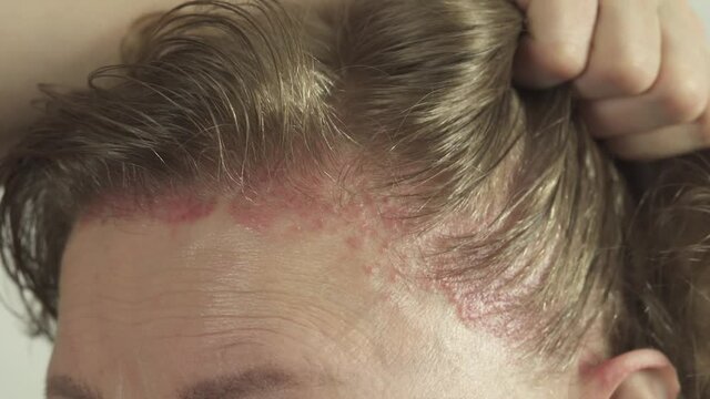 Allergy on the scalp after hair coloring. Swollen face. Skin Reaction