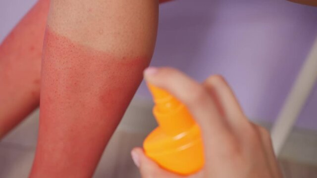 Applying of sunscreen cream on red sunburned skin, closeup